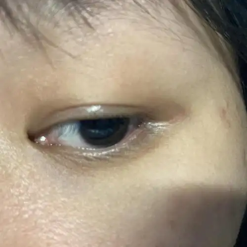 眼尾沟颜色很重怎么办,像是和黑眼圈重叠了