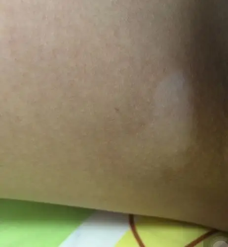 腿内侧有白斑,是白癜风吗