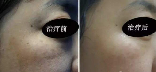 褐青色痣的临床表现和治疗