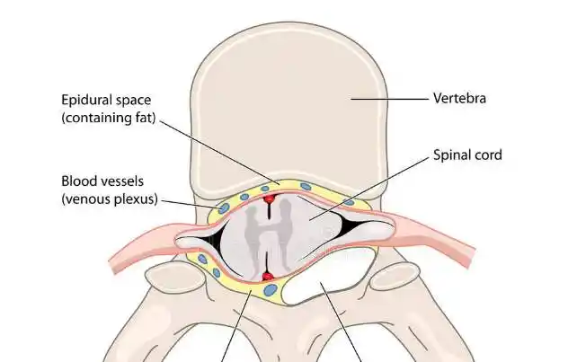 骶管囊肿和马尾神经损伤之间有什么关系吗?为什么症状很像
