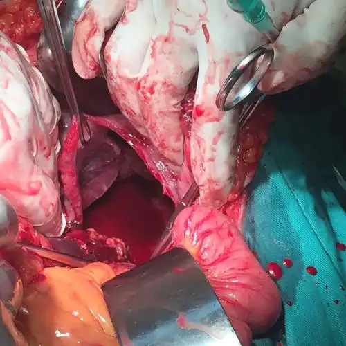 胸腹联合伤(膈肌破了个大洞) - 好大夫在线