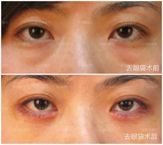 眼袋,衰老的元凶!