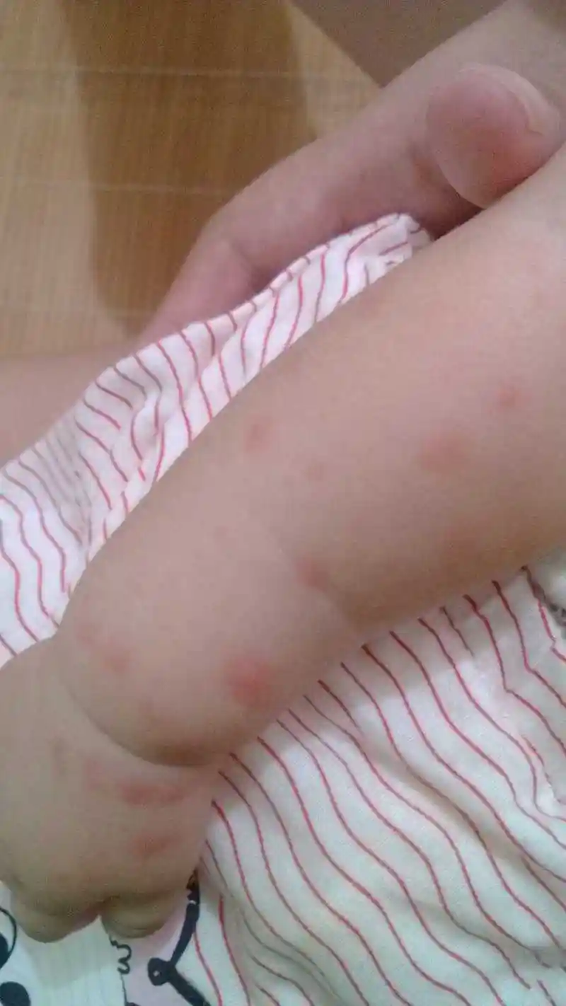 急,宝宝手臂长红疹,是什么?