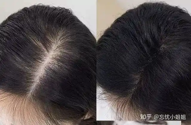 方法用的对脱发都能调理好我的生发成功经验总结