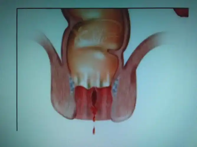 爱护肛门,减少病痛#老范讲肛裂3:_肛裂_病因_发病原因 - 好大夫在线