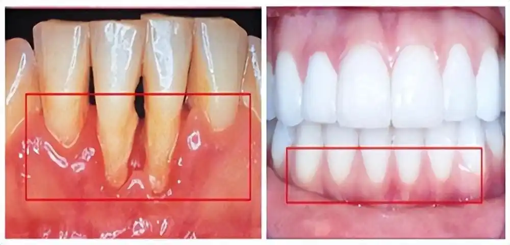 牙齿本质外露图片(牙根外露怎么解决) - 赤虎壹号