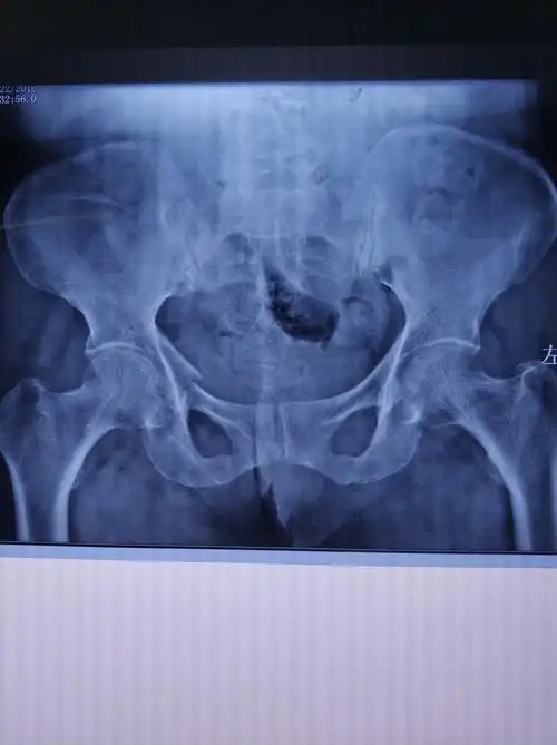 1月后复查骨盆ct