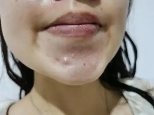 慎入这种完全封闭的硬块痘痘要怎么好