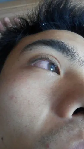 眼皮起的这是啥?