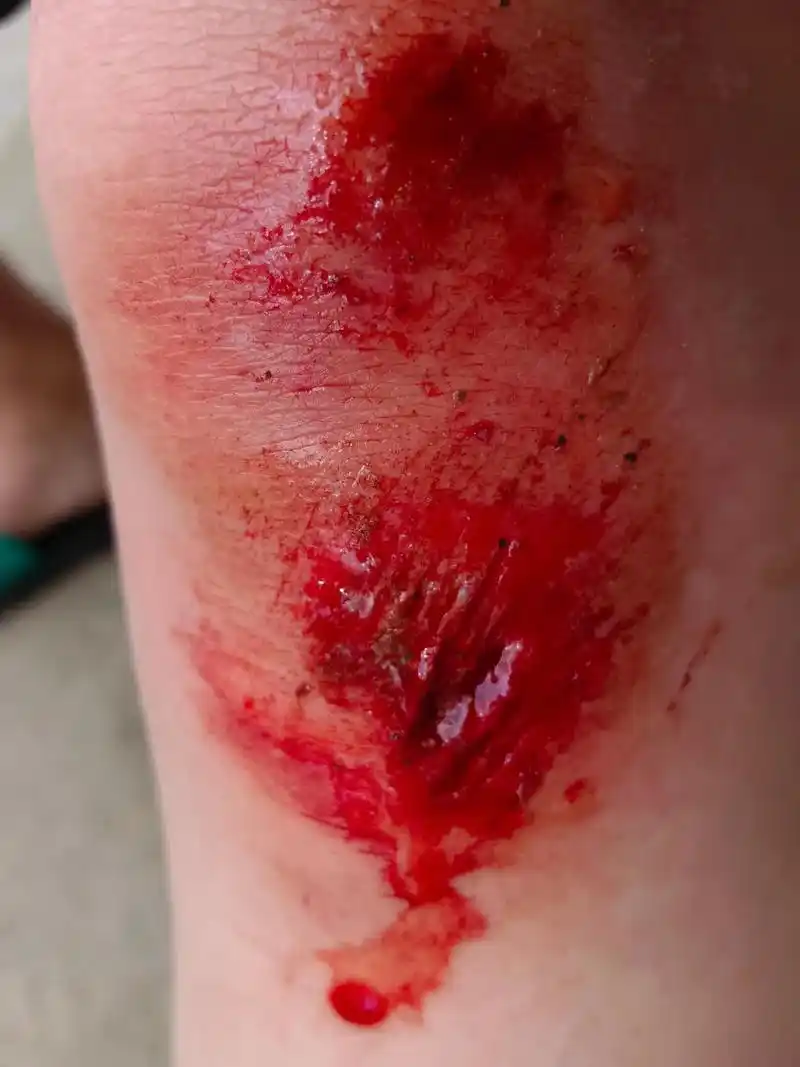 骑车摔破了膝盖  虽然很疼 但我没有怨其他因素 只怪自己不小 - 抖音