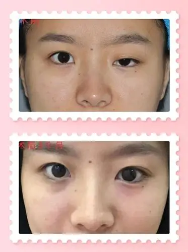 【余文林】上睑下垂自测及治疗方式_眼睑