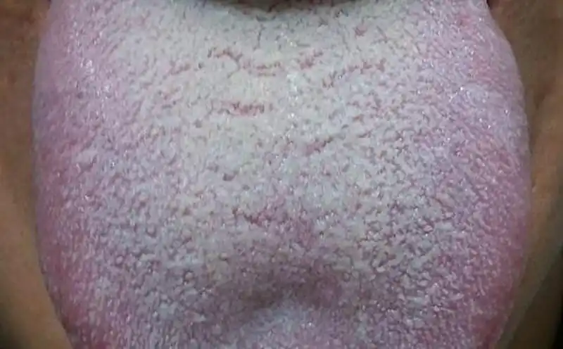 胃里总反酸水的人请看舌头,如果舌苔白厚就用这个办法