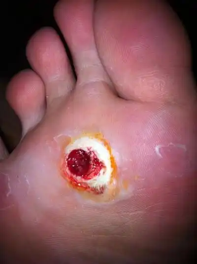 鸡眼图片初期 (50)