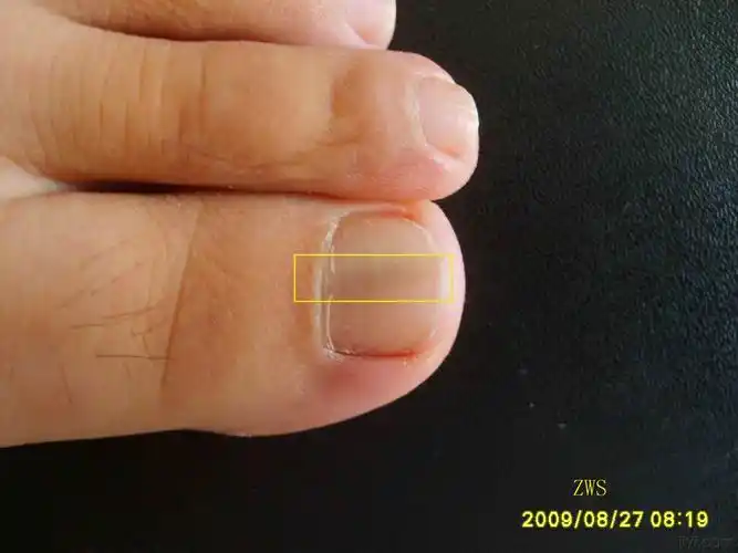 典型病例甲母痣一例