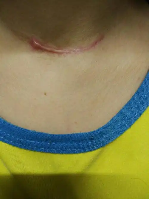 术后72天 疤痕 红肿 轻微疼痛 这样的伤口有问题吗