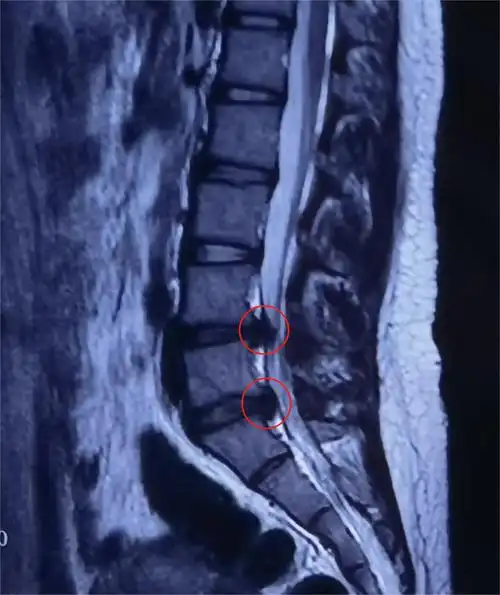 13岁胖女孩频频腰痛,竟是腰椎间盘突出得手术