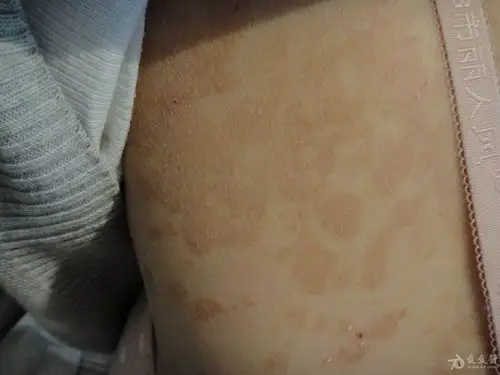 典型皮肤病之花斑癣(汗斑)