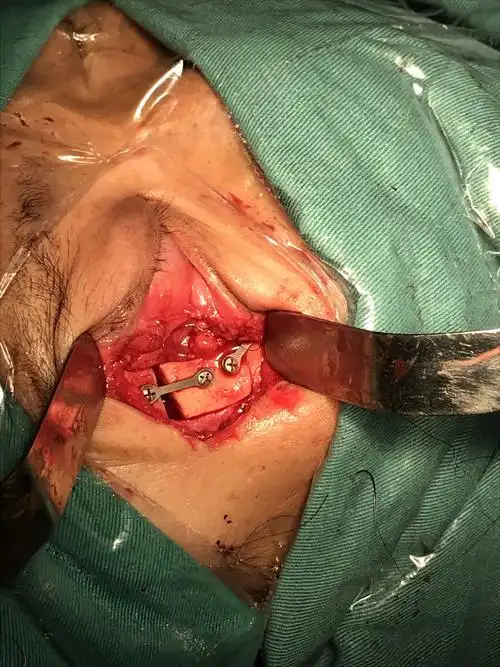 眼眶内肿瘤切除术医者版