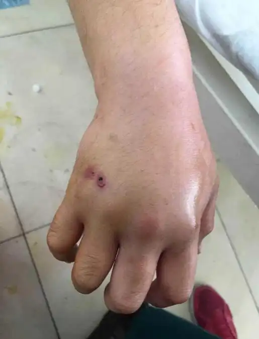 被小蛇咬了的伤口图片大全