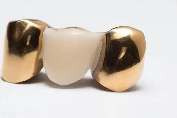 不同种类的烤瓷牙有什么区别你知道吗