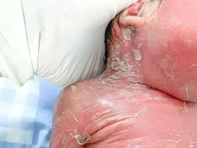 外翻,口吐泡沫,王明东根据临床经验判断,小星星为罕见的先天性鱼鳞病!