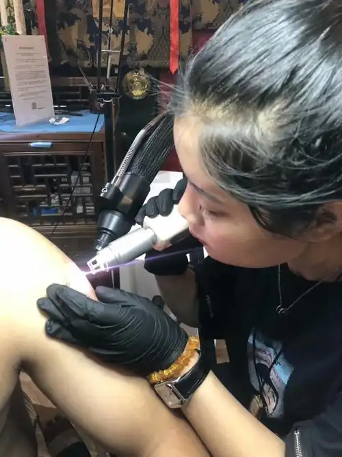 皮秒洗纹身