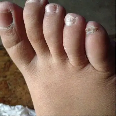 宝妈们我是不是得了灰指甲啊,帮忙看看,对宝宝有影响没有啊