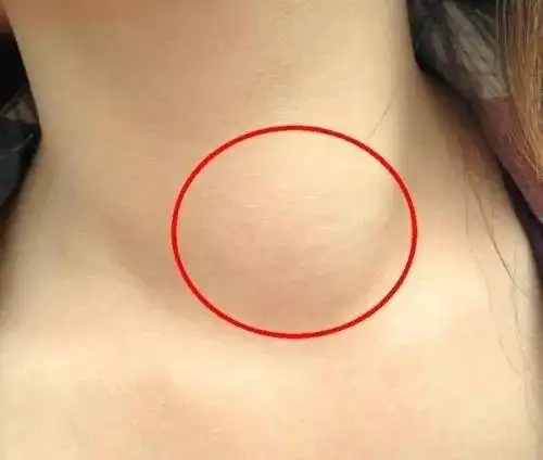 甲状腺结节的艾灸调理