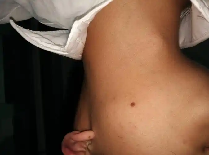 脸上黑痣厂痘痘,挤破后痣变大,几年了,想问一下会不会是黑色素