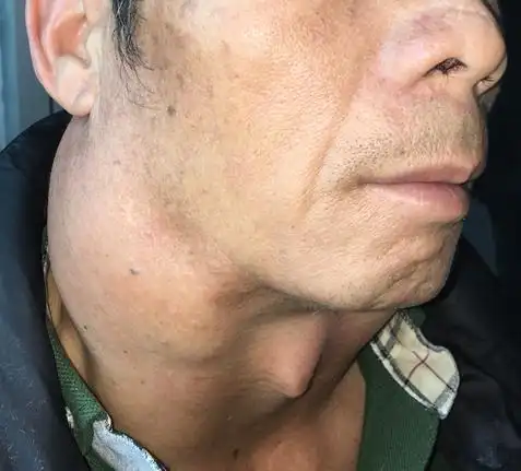 类型众多,治疗方法差异较大,包括颈动脉体瘤,神经纤维瘤,神经鞘瘤