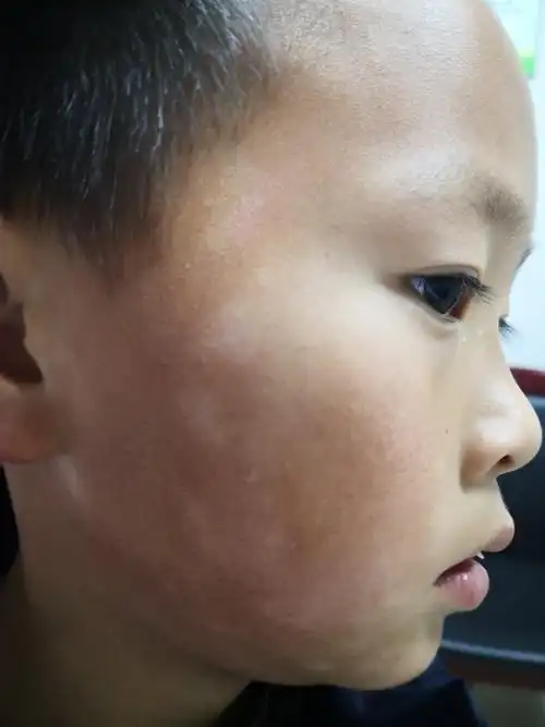 常见于儿童和青少年,好发于面部的鳞屑性色素减退斑.