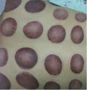 拔罐解身体不适!1图看"罐印颜色意义" 某些人千万别拔