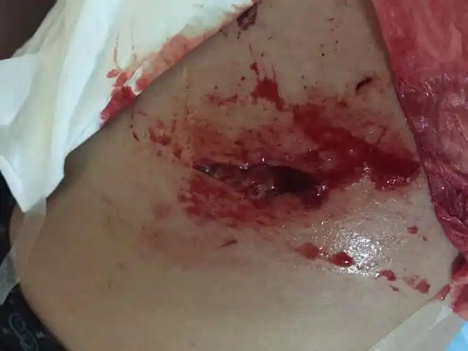 我在工地上工作时摔下来大腿缝了6针请问这个工伤应该怎么处理,老板