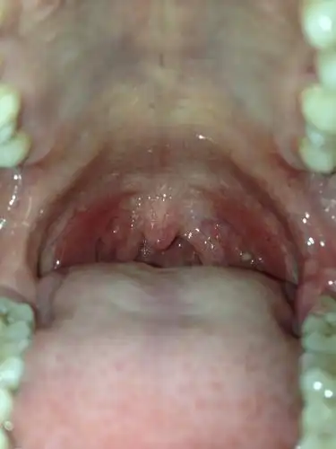 口腔白色念珠菌感染症状图片