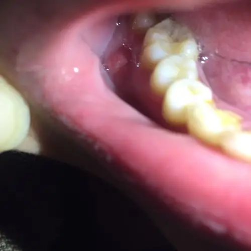 牙龈旁边长个大脓包都一两个月了,肿了,特别疼怎么办啊