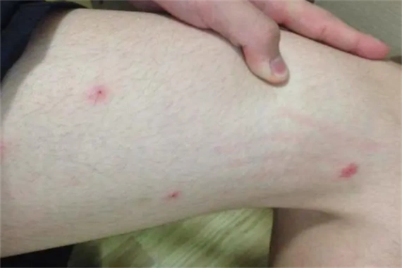 螨虫叮咬后的症状图