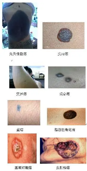 得了黑色素瘤怎么办?
