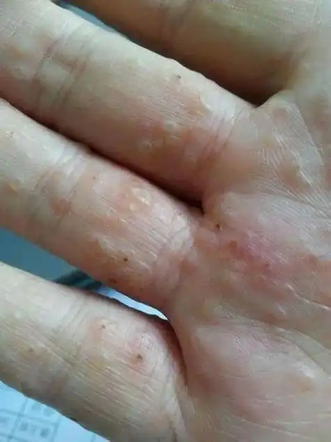 手指上出了很多密密麻麻的小水泡,用对方法,轻松搞定手指上长了很多不