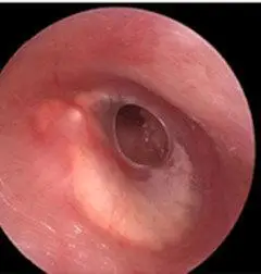 haodf:8:erjibing-->耳炎 !--haodf:/8:erjibing-->鼓膜钙化11.jpg