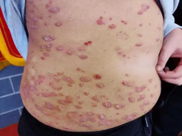 不幸的是血热论直接影响了后世医家,近现代名家及医