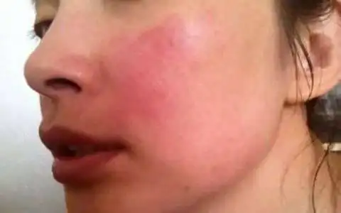 头条问答 - 过敏的体质会加速肌肤老化吗?(2个回答)