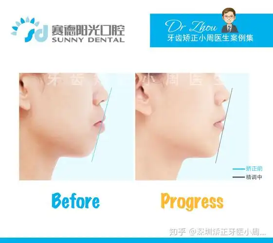 隐适美拔牙矫正上颌前突下颌后缩案例