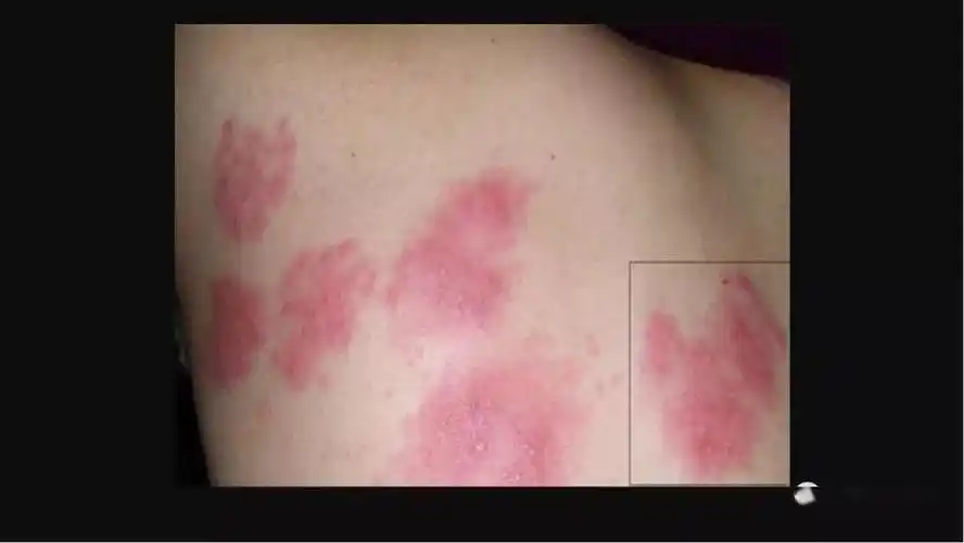 带状疱疹治疗指南