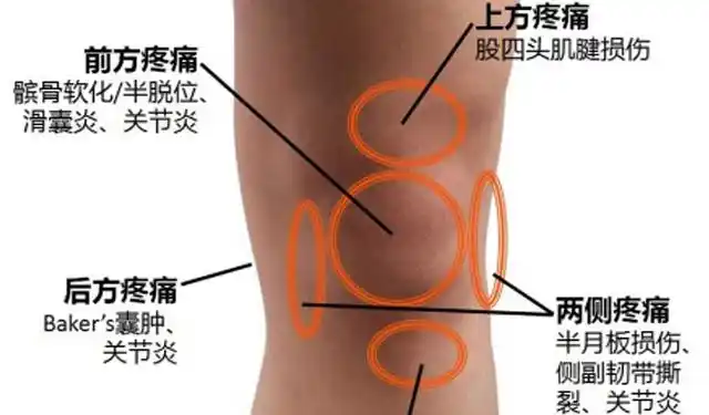 圣草康骨贴滑膜炎还在用止痛药11种后果了解一下