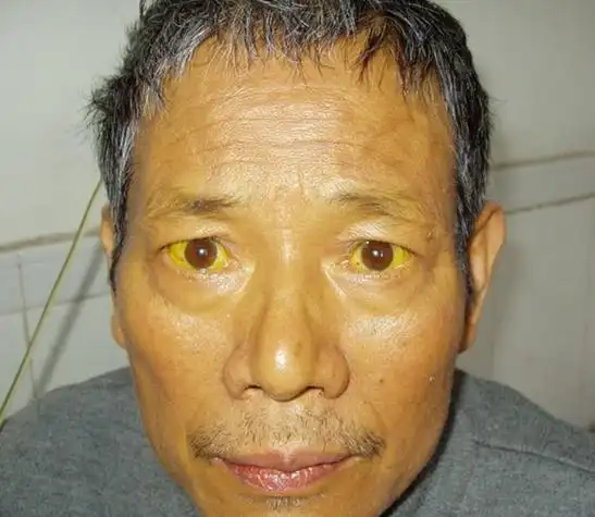 肝病面容 脸色图片_有来医生