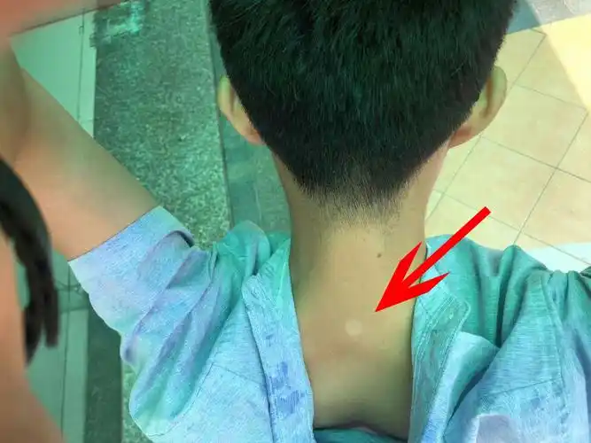 请问这个是汗斑或白癜风的问题