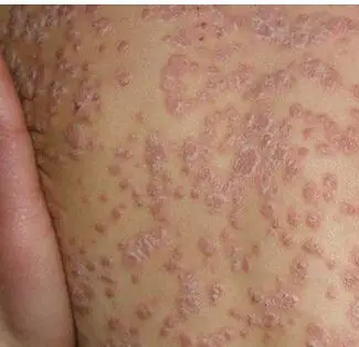 寻常型牛皮癣的疾病危害