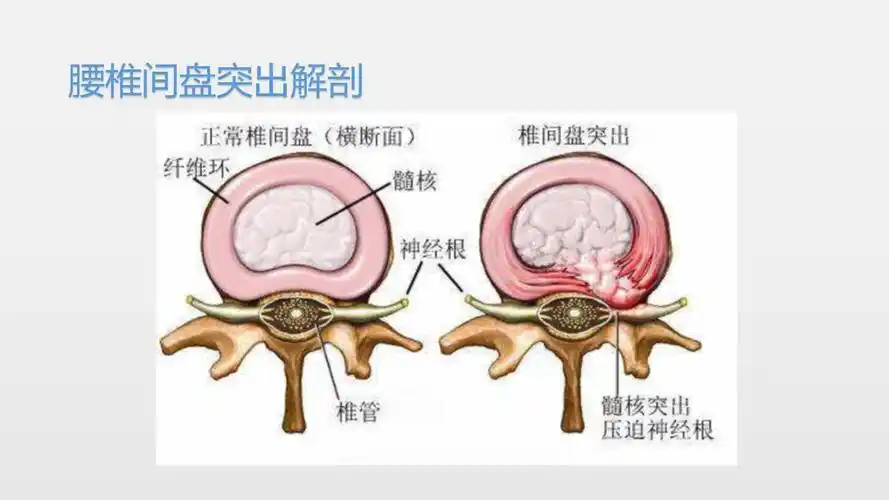 康复训练系列之六-腰椎间盘突出症 - 好大夫在线
