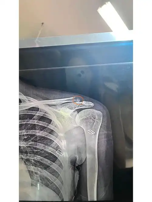 左锁骨肩峰端骨折