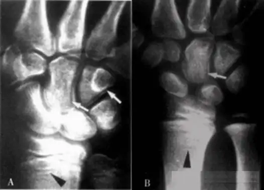 小儿的干骺端生长最活跃,在这里可以看到软骨内化骨的过程.